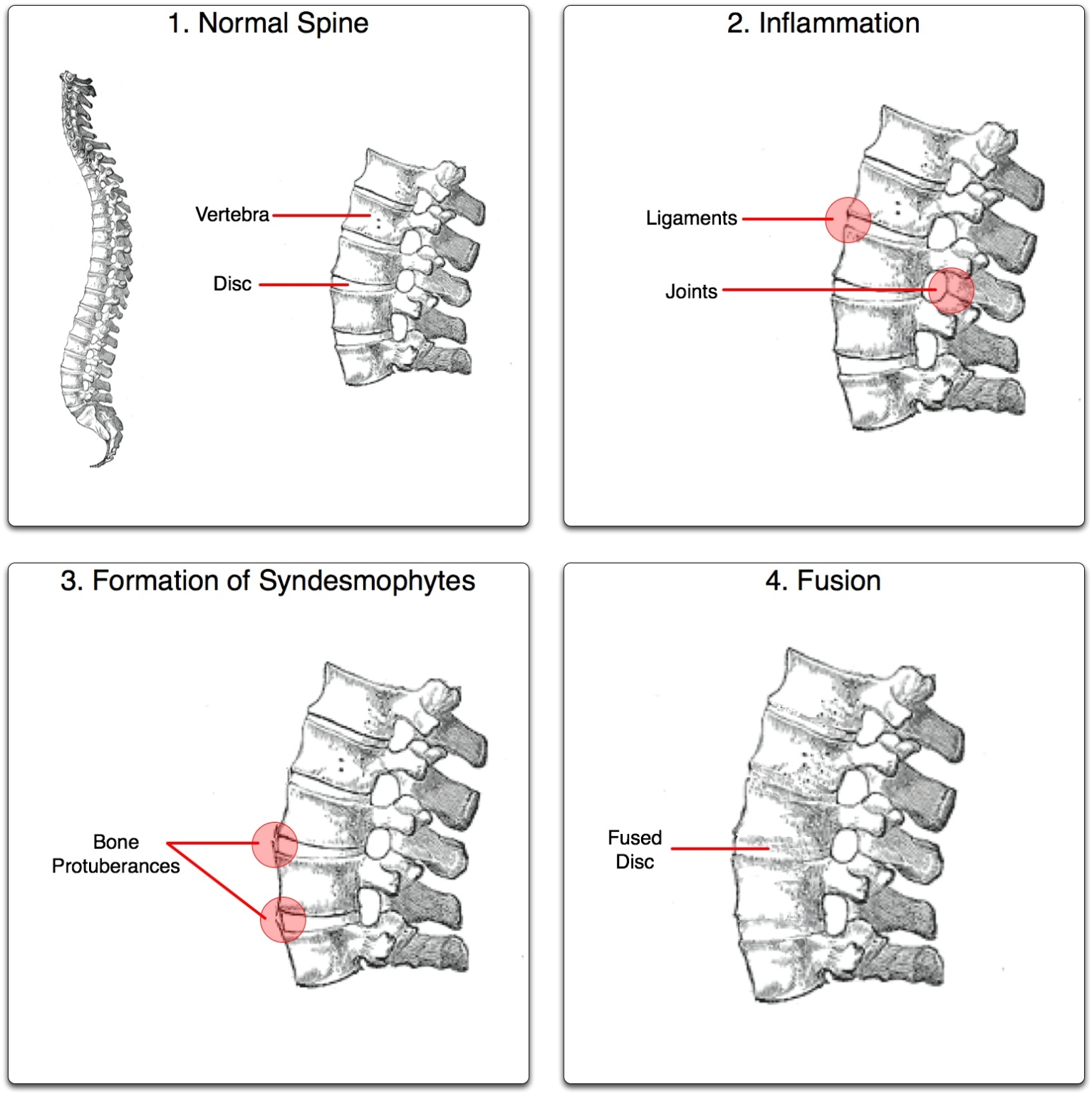 Spondylitis Ribs Ankylosing Spondylitis - ArthurCare