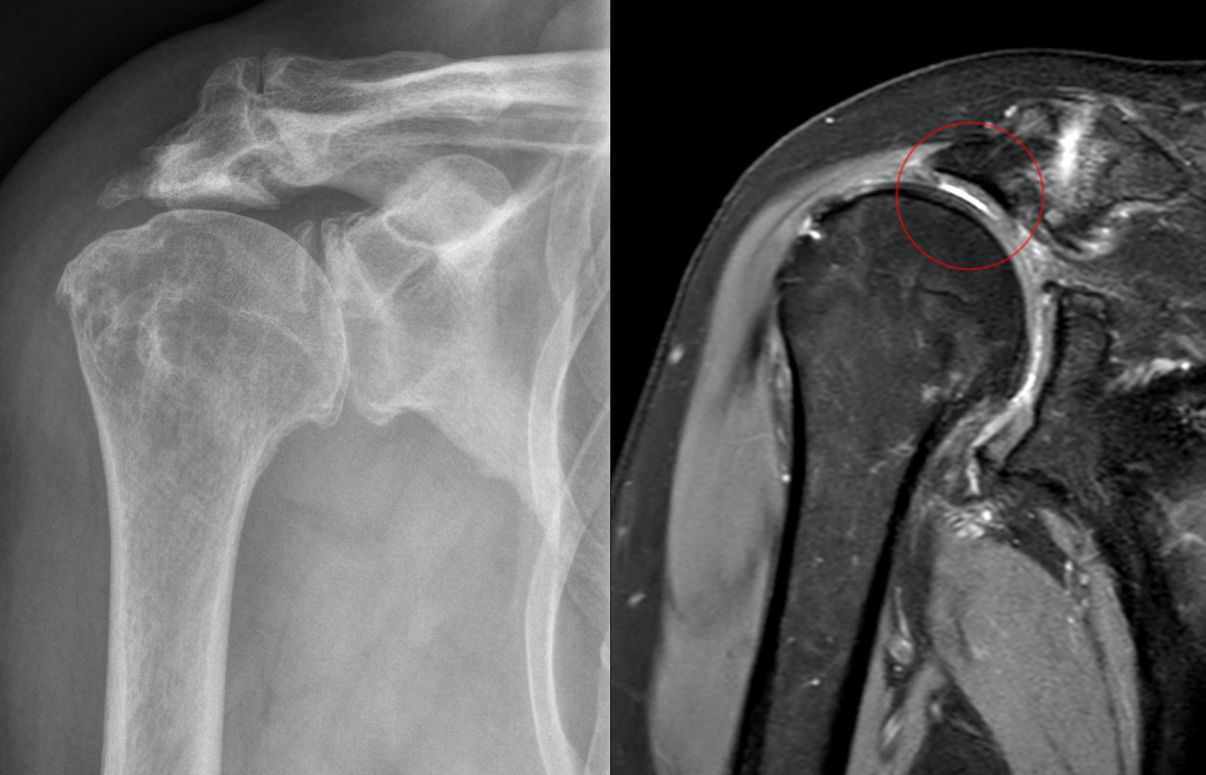 Rotator Cuff Tear Arthropathy - ArthurCare
